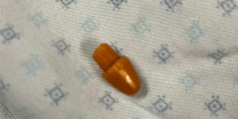 Dr. Warren Cooper retrieved this foreign piece of plastic from Baraka’s lung.